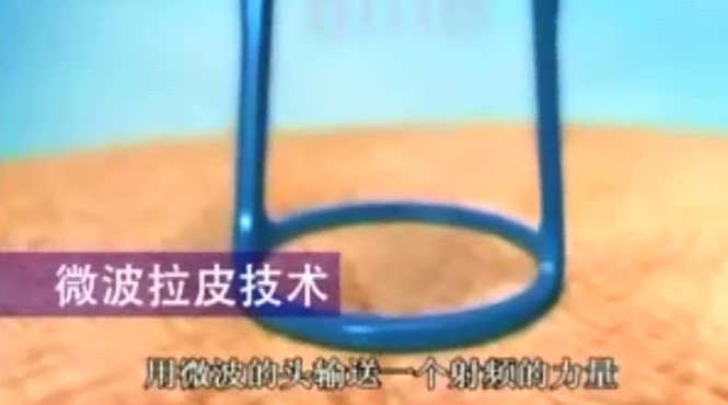 微波拉皮紧肤技术