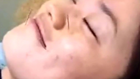 传统医学针灸祛斑法