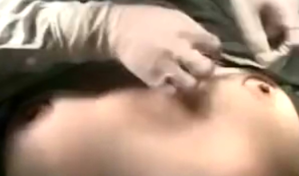 隆胸手术