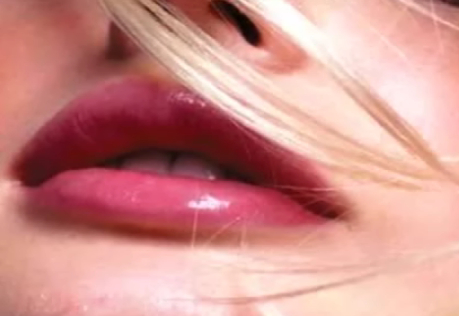 artecoll injections