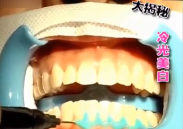 揭秘冷光美白牙齿法