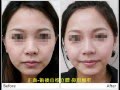 4D精雕埋线隆鼻疗程示范
