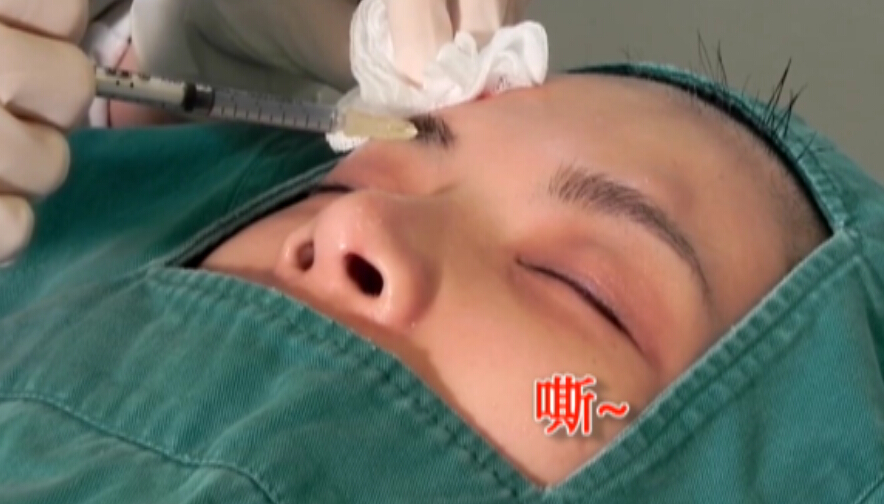 眉眼提拉埋线法