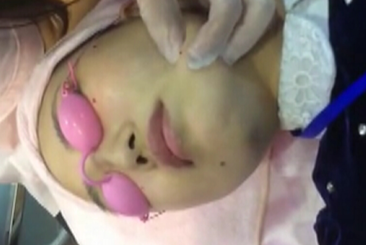 激光点痣