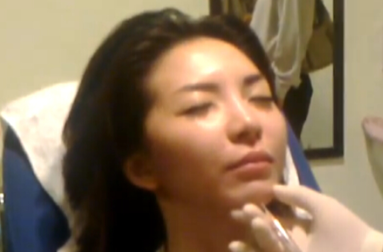 下巴整形
