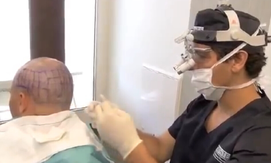 Hair transplantation