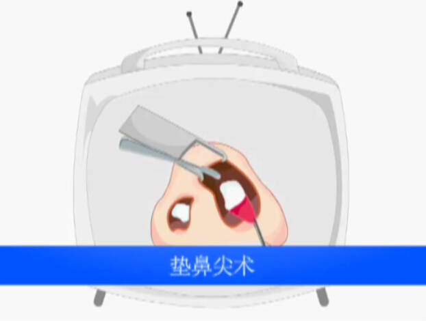 鼻子整形 垫鼻尖术