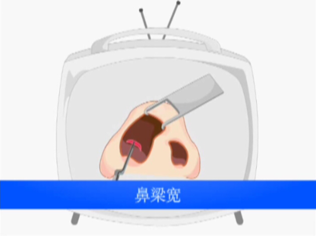 鼻子手术 缩窄宽鼻梁