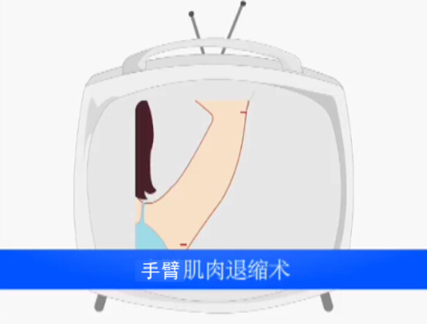手臂肌肉吸脂术