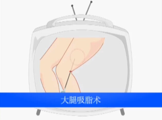 大腿吸脂术