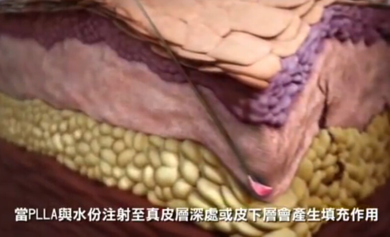 胶原渐生医学技术注射原理