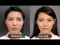 微针滚轮美容综合疗法