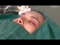 面部埋线法眉眼部提升
